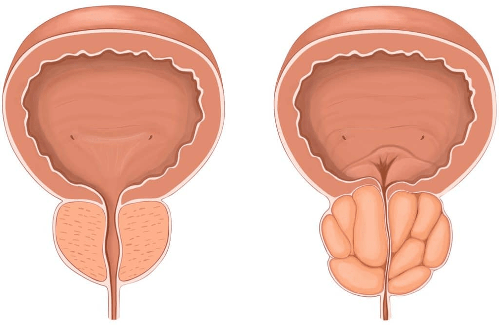 Que pasa coa próstata na prostatite