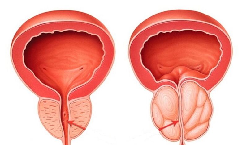 Próstata saudable e inflamada con prostatite