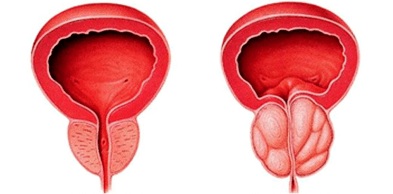 Próstata normal e inflamada